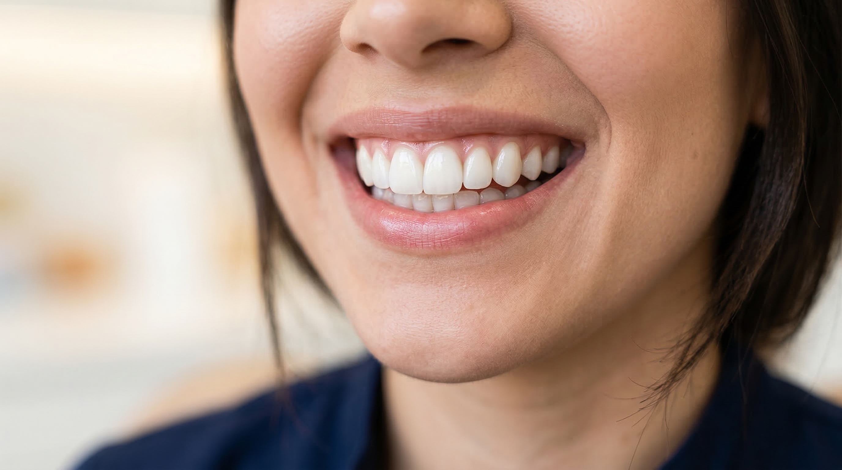 Carillas Dentales en Grupo Dental Blue