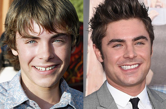 Zac Efron ejemplo de carillas